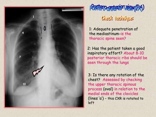 3: Is there any rotation of the
chest? Assessed by checking
the upper thoracic spinous
process (oval) in relation to the
medial ends of the clavicles
(lines ‘a’) - this CXR is rotated to
left
1
4
7
10
a
a
1: Adequate penetration of
the mediastinum-is the
thoracic spine seen?
2: Has the patient taken a good
inspiratory effort? About 8-10
posterior thoracic ribs should be
seen through the lungs
 