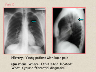 History: Young patient with back pain
Questions: Where is this lesion located?
What is your differential diagnosis?
Case 10
 
