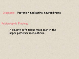 Diagnosis: Posterior mediastinal neurofibroma
Radiographic Findings:
A smooth soft tissue mass seen in the
upper posterior mediastinum
 