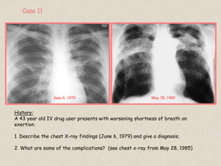 History:
A 43 year old IV drug user presents with worsening shortness of breath on
exertion.
1. Describe the chest X-ray findings (June 6, 1979) and give a diagnosis.
2. What are some of the complications? (see chest x-ray from May 28, 1985)
June 6, 1979 May 28, 1985
Case 11
 