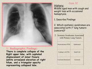 History:
Middle aged man with cough and
weight loss with occasional
hemoptysis.
1. Describe Findings
2. Which systemic syndromes are
associated with 1o
lung tumors
(cancers)?
Systemic Syndromes Associated
with Primary Lung Tumors
Hypercalcimia (PTH) Epidermoid
Cushing’s (ACTH) Small Cell
Carcinoid (Serotonin) Carcinoid
2.
1: Radiographic Findings:
There is complete collapse of the
Right upper lobe, with cephalad
displacement of minor fissure
(white arrow)and elevation of right
hilum, and a triangular opacity
representing collapsed lobe.
Case 12
 