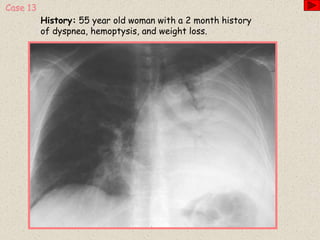 History: 55 year old woman with a 2 month history
of dyspnea, hemoptysis, and weight loss.
Case 13
 