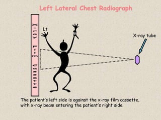 Left Lateral Chest Radiograph
X-ray tube
The patient’s left side is against the x-ray film cassette,
with x-ray beam entering the patient’s right side
Lt
Rt
 