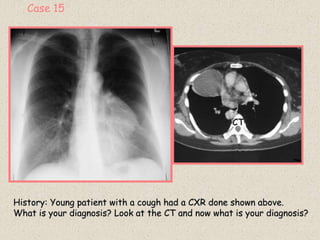 Case 15
History: Young patient with a cough had a CXR done shown above.
What is your diagnosis? Look at the CT and now what is your diagnosis?
CT
 