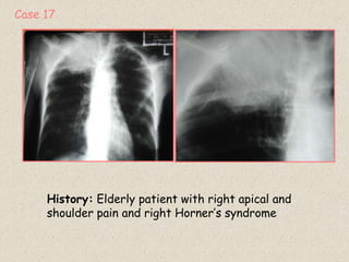 History: Elderly patient with right apical and
shoulder pain and right Horner’s syndrome
Case 17
 
