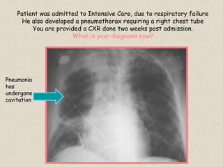 Patient was admitted to Intensive Care, due to respiratory failure
He also developed a pneumothorax requiring a right chest tube
You are provided a CXR done two weeks post admission.
What is your diagnosis now?
Pneumonia
has
undergone
cavitation
 