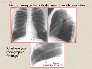 History: Young patient with shortness of breath on exertion.
What are your
radiographic
findings?
P.A
Lateral
Close up
close up of RLL
Case 20
 