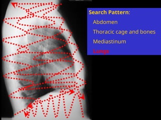 chest radiology details of interptetation .ppt
