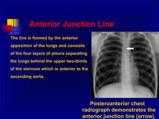 chest radiology details of interptetation .ppt