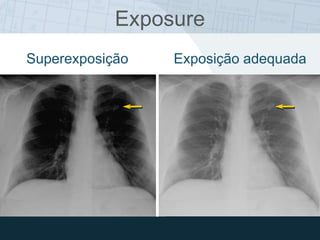 Superexposição Exposição adequada
Exposure
 