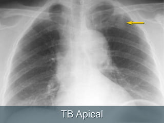 TB Apical
 