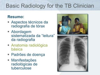 Basic Radiology for the TB Clinician
Resumo:
 Aspectos técnicos da
radiografia de tórax
 Abordagem
sistematizada da “leitura”
da radiografia
 Anatomia radiológica
básica
 Padrões de doença
 Manifestações
radiológicas de
tuberculose
 