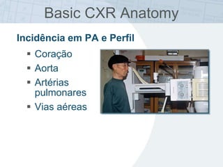 Basic CXR Anatomy
Incidência em PA e Perfil
 Coração
 Aorta
 Artérias
pulmonares
 Vias aéreas
 