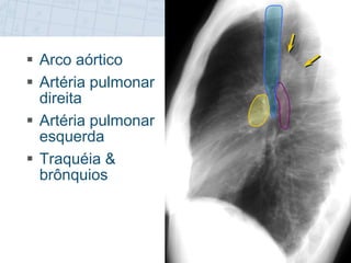  Arco aórtico
 Artéria pulmonar
direita
 Artéria pulmonar
esquerda
 Traquéia &
brônquios
 