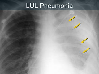 LUL Pneumonia
 