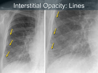Interstitial Opacity: Lines
 