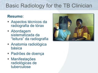 Resumo:
 Aspectos técnicos da
radiografia de tórax
 Abordagem
sistematizada da
“leitura” da radiografia
 Anatomia radiológica
básica
 Padrões de doença
 Manifestações
radiológicas de
tuberculose
Basic Radiology for the TB Clinician
 