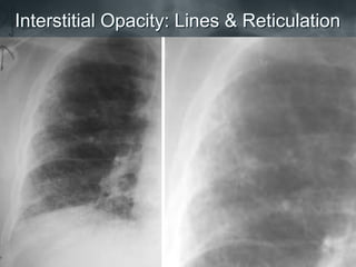 Interstitial Opacity: Lines & Reticulation
 
