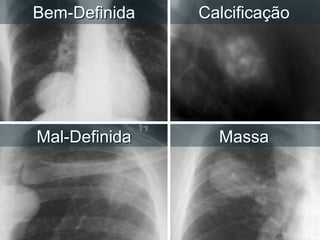 Bem-Definida Calcificação
Mal-Definida Massa
 