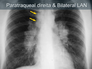 Paratraqueal direita & Bilateral LAN
 