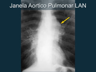 Janela Aortico Pulmonar LAN
 
