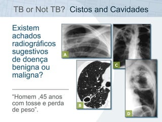 TB or Not TB? Cistos and Cavidades
A
“Homem ,45 anos
com tosse e perda
de peso”.
Existem
achados
radiográficos
sugestivos
de doença
benigna ou
maligna?
C
D
B
 