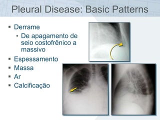  Derrame
• De apagamento de
seio costofrênico a
massivo
 Espessamento
 Massa
 Ar
 Calcificação
Pleural Disease: Basic Patterns
 