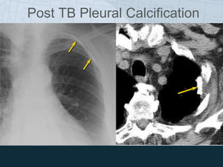 Post TB Pleural Calcification
 