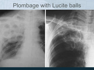 Plombage with Lucite balls
 