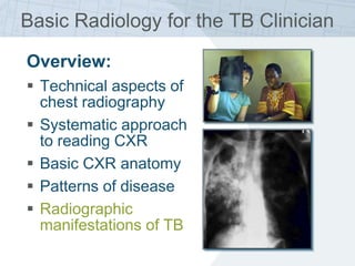 Basic Radiology for the TB Clinician
Overview:
 Technical aspects of
chest radiography
 Systematic approach
to reading CXR
 Basic CXR anatomy
 Patterns of disease
 Radiographic
manifestations of TB
 
