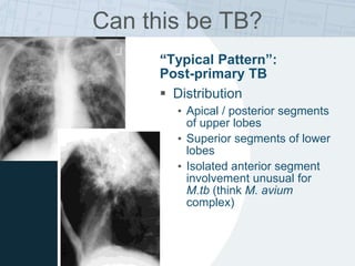 “Typical Pattern”:
Post-primary TB
 Distribution
• Apical / posterior segments
of upper lobes
• Superior segments of lower
lobes
• Isolated anterior segment
involvement unusual for
M.tb (think M. avium
complex)
Can this be TB?
 