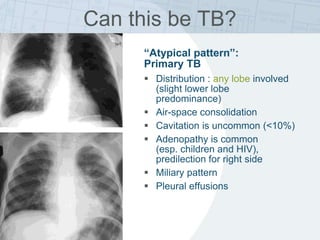 “Atypical pattern”:
Primary TB
 Distribution : any lobe involved
(slight lower lobe
predominance)
 Air-space consolidation
 Cavitation is uncommon (<10%)
 Adenopathy is common
(esp. children and HIV),
predilection for right side
 Miliary pattern
 Pleural effusions
Can this be TB?
 