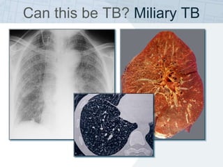 Can this be TB? Miliary TB
 