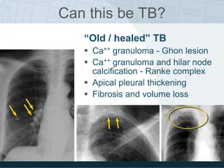 “Old / healed” TB
 Ca++ granuloma - Ghon lesion
 Ca++ granuloma and hilar node
calcification - Ranke complex
 Apical pleural thickening
 Fibrosis and volume loss
Can this be TB?
 