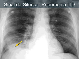 Silhouette Sign: RLL PneumoniaSinal da Silueta : Pneumonia LID
 