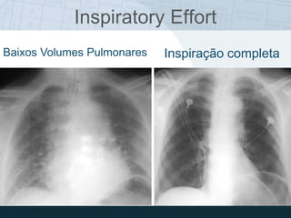 Inspiratory Effort
Baixos Volumes Pulmonares Inspiração completa
 