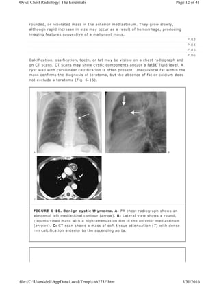 rounded, or lobulated mass in the anterior mediastinum. They grow slowly,
although rapid increase in size may occur as a result of hemorrhage, producing
imaging features suggestive of a malignant mass.
Calcification, ossification, teeth, or fat may be visible on a chest radiograph and
on CT scans. CT scans may show cystic components and/or a fatâ€“fluid level. A
cyst wall with curvilinear calcification is often present. Unequivocal fat within the
mass confirms the diagnosis of teratoma, but the absence of fat or calcium does
not exclude a teratoma (Fig. 6-16).
P.83
P.84
P.85
P.86
FIGURE 6-10. Benign cystic thymoma. A: PA chest radiograph shows an
abnormal left mediastinal contour (arrow). B: Lateral view shows a round,
circumscribed mass with a high-attenuation rim in the anterior mediastinum
(arrows). C: CT scan shows a mass of soft tissue attenuation (T) with dense
rim calcification anterior to the ascending aorta.
Page 12 of 41Ovid: Chest Radiology: The Essentials
5/31/2016file://C:UsersdellAppDataLocalTemp~hh273F.htm
 