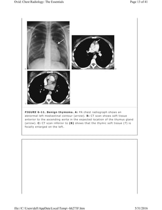 FIGURE 6-11. Benign thymoma. A: PA chest radiograph shows an
abnormal left mediastinal contour (arrow). B: CT scan shows soft tissue
anterior to the ascending aorta in the expected location of the thymus gland
(arrow). C: CT scan inferior to (B) shows that the thymic soft tissue (T) is
focally enlarged on the left.
Page 13 of 41Ovid: Chest Radiology: The Essentials
5/31/2016file://C:UsersdellAppDataLocalTemp~hh273F.htm
 