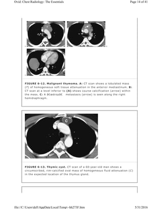 FIGURE 6-12. Malignant thymoma. A: CT scan shows a lobulated mass
(T) of homogeneous soft tissue attenuation in the anterior mediastinum. B:
CT scan at a level inferior to (A) shows course calcification (arrow) within
the mass. C: A â€œdropâ€ metastasis (arrow) is seen along the right
hemidiaphragm.
FIGURE 6-13. Thymic cyst. CT scan of a 60-year-old man shows a
circumscribed, rim-calcified oval mass of homogeneous fluid attenuation (C)
in the expected location of the thymus gland.
Page 14 of 41Ovid: Chest Radiology: The Essentials
5/31/2016file://C:UsersdellAppDataLocalTemp~hh273F.htm
 