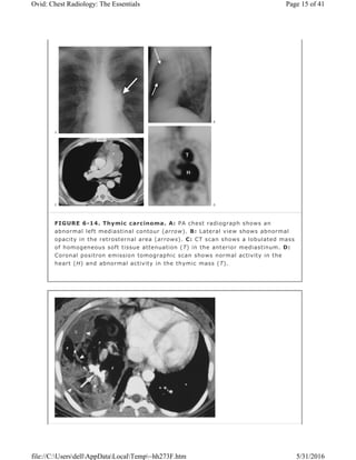 FIGURE 6-14. Thymic carcinoma. A: PA chest radiograph shows an
abnormal left mediastinal contour (arrow). B: Lateral view shows abnormal
opacity in the retrosternal area (arrows). C: CT scan shows a lobulated mass
of homogeneous soft tissue attenuation (T) in the anterior mediastinum. D:
Coronal positron emission tomographic scan shows normal activity in the
heart (H) and abnormal activity in the thymic mass (T).
Page 15 of 41Ovid: Chest Radiology: The Essentials
5/31/2016file://C:UsersdellAppDataLocalTemp~hh273F.htm
 