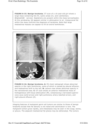Imaging features of malignant germ cell tumors are similar to those of benign
teratoma except that fat density is not noted and calcification is rare. The
malignant tumors grow rapidly, and metastases may be seen in the lungs, bones,
or pleura. The adjacent mediastinal fat planes may be obliterated. The tumors
FIGURE 6-15. Benign teratoma. CT scan of a 16-year-old girl shows a
large mass containing fat (F), cystic areas (C), and rudimentary
â€œteethâ€ (arrow). Septations are present within the mass (arrowheads).
At this windowing, fat appears similar in attenuation to air. Unequivocal fat
within the mass confirms the diagnosis of teratoma. Note that large
mediastinal masses can appear to fill an entire hemithorax.
FIGURE 6-16. Benign teratoma. A: PA chest radiograph shows abnormal
opacity in the right hemithorax, some of which is caused by pleural effusion,
and mediastinal shift to the left. B: Lateral view shows abnormal opacity in
the retrosternal area. C: CT scan shows an anterior mediastinal mass of
homogeneous soft tissue attenuation (M), compressing a narrowed superior
vena cava (solid arrow) and right pulmonary artery (dashed arrow), and
right pleural effusion (E).
Page 16 of 41Ovid: Chest Radiology: The Essentials
5/31/2016file://C:UsersdellAppDataLocalTemp~hh273F.htm
 