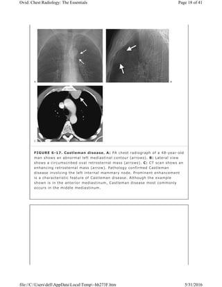 FIGURE 6-17. Castleman disease. A: PA chest radiograph of a 48-year-old
man shows an abnormal left mediastinal contour (arrows). B: Lateral view
shows a circumscribed oval retrosternal mass (arrows). C: CT scan shows an
enhancing retrosternal mass (arrow). Pathology confirmed Castleman
disease involving the left internal mammary node. Prominent enhancement
is a characteristic feature of Castleman disease. Although the example
shown is in the anterior mediastinum, Castleman disease most commonly
occurs in the middle mediastinum.
Page 18 of 41Ovid: Chest Radiology: The Essentials
5/31/2016file://C:UsersdellAppDataLocalTemp~hh273F.htm
 