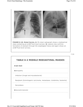 FIGURE 6-18. Hiatal hernia. A: PA chest radiograph shows a mediastinal
mass containing an airâ€“fluid level (arrow). B: Lateral view confirms
herniation of stomach through the esophageal hiatus and again shows an
airâ€“fluid level (arrow).
P.88
TABLE 6-2 MIDDLE MEDIASTINAL MASSES
â€œ3 Asâ€
Adenopathy
Infection (fungal and mycobacterial)
Neoplasm (bronchogenic carcinoma, metastases, lymphoma, leukemia)
Sarcoidosis
Aneurysm/vascular
Page 19 of 41Ovid: Chest Radiology: The Essentials
5/31/2016file://C:UsersdellAppDataLocalTemp~hh273F.htm
 