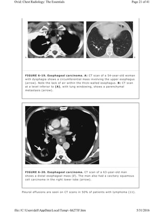 Pleural effusions are seen on CT scans in 50% of patients with lymphoma (11).
FIGURE 6-19. Esophageal carcinoma. A: CT scan of a 54-year-old woman
with dysphagia shows a circumferential mass involving the upper esophagus
(arrow). Note the lack of air within the thick-walled esophagus. B: CT scan
at a level inferior to (A), with lung windowing, shows a parenchymal
metastasis (arrow).
FIGURE 6-20. Esophageal carcinoma. CT scan of a 63-year-old man
shows a distal esophageal mass (E). The man also had a cavitary squamous
cell carcinoma in the right lower lobe (arrow).
Page 21 of 41Ovid: Chest Radiology: The Essentials
5/31/2016file://C:UsersdellAppDataLocalTemp~hh273F.htm
 