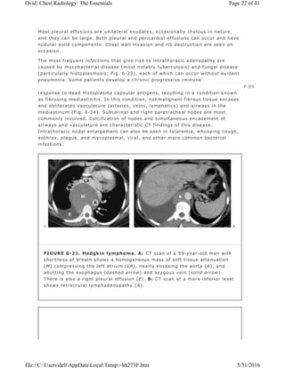 Most pleural effusions are unilateral exudates, occasionally chylous in nature,
and they can be large. Both pleural and pericardial effusions can occur and have
nodular solid components. Chest wall invasion and rib destruction are seen on
occasion.
The most frequent infections that give rise to intrathoracic adenopathy are
caused by mycobacterial disease (most notably tuberculosis) and fungal disease
(particularly histoplasmosis; Fig. 6-23), each of which can occur without evident
pneumonia. Some patients develop a chronic progressive immune
response to dead Histoplasma capsular antigens, resulting in a condition known
as fibrosing mediastinitis. In this condition, nonmalignant fibrous tissue encases
and obliterates vasculature (arteries, veins, lymphatics) and airways in the
mediastinum (Fig. 6-24). Subcarinal and right paratracheal nodes are most
commonly involved. Calcification of nodes and simultaneous encasement of
airways and vasculature are characteristic CT findings of this disease.
Intrathoracic nodal enlargement can also be seen in tularemia, whooping cough,
anthrax, plague, and mycoplasmal, viral, and other more common bacterial
infections.
P.89
FIGURE 6-21. Hodgkin lymphoma. A: CT scan of a 59-year-old man with
shortness of breath shows a homogeneous mass of soft tissue attenuation
(M) compressing the left atrium (LA), nearly encasing the aorta (A), and
abutting the esophagus (dashed arrow) and azygous vein (solid arrow).
There is also a right pleural effusion (E). B: CT scan at a more inferior level
shows retrocrural lymphadenopathy (A).
Page 22 of 41Ovid: Chest Radiology: The Essentials
5/31/2016file://C:UsersdellAppDataLocalTemp~hh273F.htm
 
