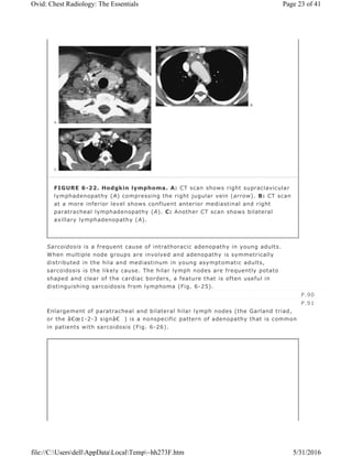 Sarcoidosis is a frequent cause of intrathoracic adenopathy in young adults.
When multiple node groups are involved and adenopathy is symmetrically
distributed in the hila and mediastinum in young asymptomatic adults,
sarcoidosis is the likely cause. The hilar lymph nodes are frequently potato
shaped and clear of the cardiac borders, a feature that is often useful in
distinguishing sarcoidosis from lymphoma (Fig. 6-25).
Enlargement of paratracheal and bilateral hilar lymph nodes (the Garland triad,
or the â€œ1-2-3 signâ€ ) is a nonspecific pattern of adenopathy that is common
in patients with sarcoidosis (Fig. 6-26).
FIGURE 6-22. Hodgkin lymphoma. A: CT scan shows right supraclavicular
lymphadenopathy (A) compressing the right jugular vein (arrow). B: CT scan
at a more inferior level shows confluent anterior mediastinal and right
paratracheal lymphadenopathy (A). C: Another CT scan shows bilateral
axillary lymphadenopathy (A).
P.90
P.91
Page 23 of 41Ovid: Chest Radiology: The Essentials
5/31/2016file://C:UsersdellAppDataLocalTemp~hh273F.htm
 
