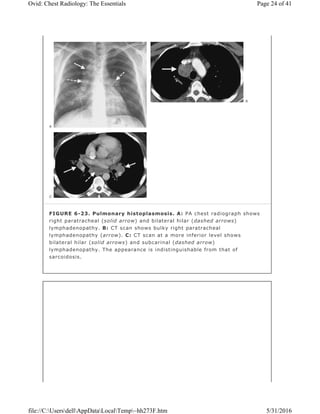 FIGURE 6-23. Pulmonary histoplasmosis. A: PA chest radiograph shows
right paratracheal (solid arrow) and bilateral hilar (dashed arrows)
lymphadenopathy. B: CT scan shows bulky right paratracheal
lymphadenopathy (arrow). C: CT scan at a more inferior level shows
bilateral hilar (solid arrows) and subcarinal (dashed arrow)
lymphadenopathy. The appearance is indistinguishable from that of
sarcoidosis.
Page 24 of 41Ovid: Chest Radiology: The Essentials
5/31/2016file://C:UsersdellAppDataLocalTemp~hh273F.htm
 