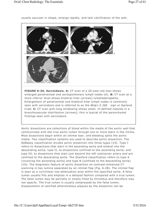 usually saccular in shape, enlarge rapidly, and lack calcification of the wall.
Aortic dissections are collections of blood within the media of the aortic wall that
communicate with the true aortic lumen through one or more tears in the intima.
Most dissections begin within an intimal tear, and bleeding splits the aortic
media. Two classification systems are used to describe aortic dissection. The
DeBakey classification divides aortic dissection into three types (15). Type I
refers to dissections that start in the ascending aorta and extend into the
descending aorta; type II, to dissections confined to the ascending aorta; and
type III, to dissections that start just beyond the left subclavian artery and are
confined to the descending aorta. The Stanford classification refers to type A
(involving the ascending aorta) and type B (confined to the descending aorta)
(16). The diagnostic feature of aortic dissection on contrast-enhanced CT
scanning is two lumina separated by an intimal flap (Fig. 6-28). The intimal flap
is seen as a curvilinear low-attenuation area within the opacified aorta. A false
lumen usually fills and empties in a delayed fashion compared with a true lumen.
The false lumen may be partially or totally filled by thrombus and therefore may
not opacify. The true lumen is usually compressed by the false lumen.
Displacement of calcified atheromatous plaques by the dissection can be
FIGURE 6-26. Sarcoidosis. A: CT scan of a 20-year-old man shows
enlarged paratracheal and aortopulmonary lymph nodes (A). B: CT scan at a
more inferior level shows bilateral hilar (arrows) lymphadenopathy.
Enlargement of paratracheal and bilateral hilar lymph nodes is commonly
seen with sarcoidosis and is referred to as the â€œ1-2-3â€ sign or Garland
triad. C: CT scan with lung windowing shows small, ill-defined nodules in a
bronchovascular distribution (arrows); this is typical of the parenchymal
findings seen with sarcoidosis.
Page 27 of 41Ovid: Chest Radiology: The Essentials
5/31/2016file://C:UsersdellAppDataLocalTemp~hh273F.htm
 