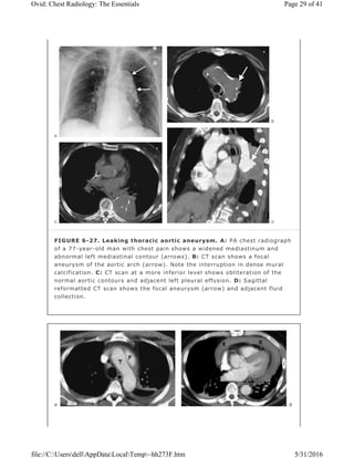FIGURE 6-27. Leaking thoracic aortic aneurysm. A: PA chest radiograph
of a 77-year-old man with chest pain shows a widened mediastinum and
abnormal left mediastinal contour (arrows). B: CT scan shows a focal
aneurysm of the aortic arch (arrow). Note the interruption in dense mural
calcification. C: CT scan at a more inferior level shows obliteration of the
normal aortic contours and adjacent left pleural effusion. D: Sagittal
reformatted CT scan shows the focal aneurysm (arrow) and adjacent fluid
collection.
Page 29 of 41Ovid: Chest Radiology: The Essentials
5/31/2016file://C:UsersdellAppDataLocalTemp~hh273F.htm
 