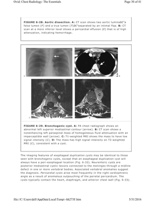 The imaging features of esophageal duplication cysts may be identical to those
seen with bronchogenic cysts, except that an esophageal duplication cyst will
always have a peri-esophageal location (Fig. 6-32). Neurenteric cysts are
posterior mediastinal cystic lesions connected to the meninges through a midline
defect in one or more vertebral bodies. Associated vertebral anomalies suggest
the diagnosis. Pericardial cysts arise most frequently in the right cardiophrenic
angle as a result of anomalous outpouching of the parietal pericardium. The
cysts typically contact the heart, diaphragm, and anterior chest wall (Fig. 6-33).
FIGURE 6-28. Aortic dissection. A: CT scan shows two aortic luminaâ€”a
false lumen (F) and a true lumen (T)â€”separated by an intimal flap. B: CT
scan at a more inferior level shows a pericardial effusion (E) that is of high
attenuation, indicating hemorrhage.
FIGURE 6-29. Bronchogenic cyst. A: PA chest radiograph shows an
abnormal left superior mediastinal contour (arrow). B: CT scan shows a
nonenhancing left paraspinal mass of homogeneous fluid attenuation with an
imperceptible wall (arrow). C: T1-weighted MRI shows the mass to have low
signal intensity (C). D: The mass has high signal intensity on T2-weighted
MRI (C), consistent with a cyst.
Page 30 of 41Ovid: Chest Radiology: The Essentials
5/31/2016file://C:UsersdellAppDataLocalTemp~hh273F.htm
 
